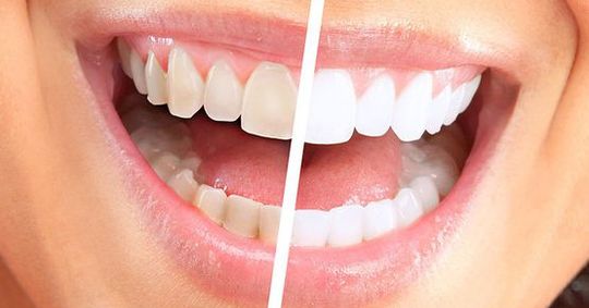 Clareamento Dental
