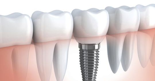 Implante dentário: conheça os principais mitos e verdades