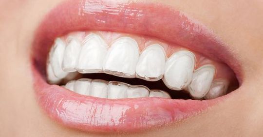 Invisalign