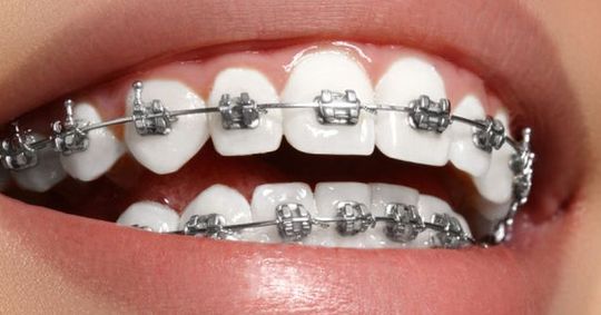 Aparelho dentário: vale a pena usar quando adulto?